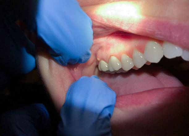 Best Emergency Gum Treatment in Newberg, OR